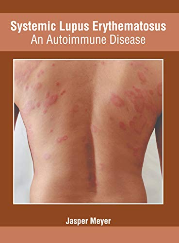 Systemic Lupus Erythematosus An Autoimmune Disease [Hardcover]