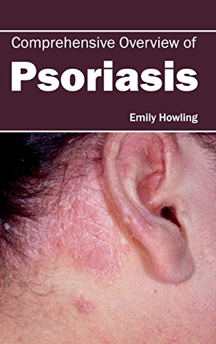 Comprehensive Overvie Of Psoriasis [Hardcover]