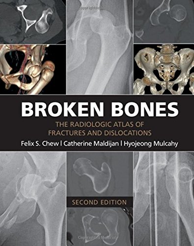 Broken Bones: The Radiologic Atlas of Fractures and Dislocations [Paperback]