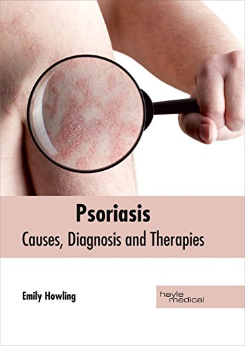 Psoriasis Causes, Diagnosis And Therapies [Hardcover]