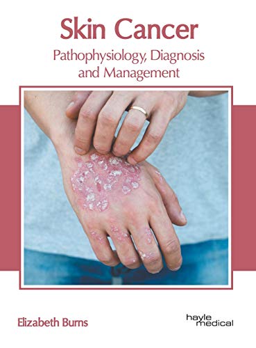 Skin Cancer Pathophysiology, Diagnosis and Management [Hardcover]