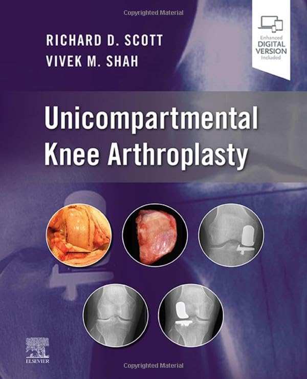 Unicompartmental Knee Arthroplasty [Hardcover]